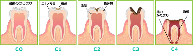 虫歯の進行